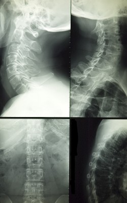 X-Ray Image